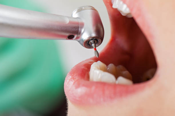 Best Lost Filling or Crown Replacement in Withamsville, OH